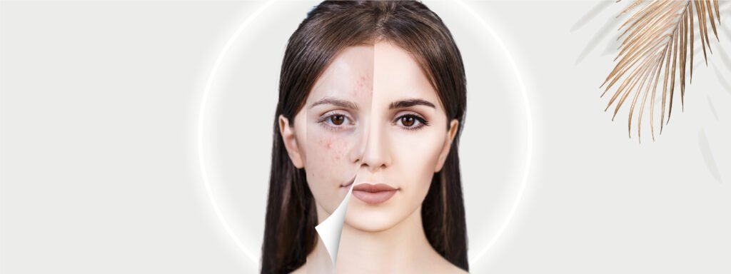 Understanding Acne and Reversing the Damage to the Skin