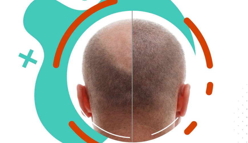 Scalp micro-pigmentation - an Instant Solution to Thin Hair