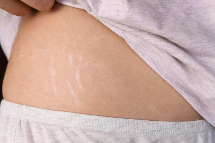 How to prevent stretch marks – Close-up of stretch marks on the lower abdomen, showcasing a common area for prevention treatments.