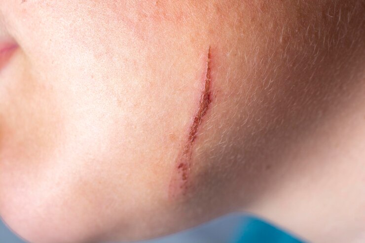 Advanced Accidental Scar Treatments at Keha Skin Clinic