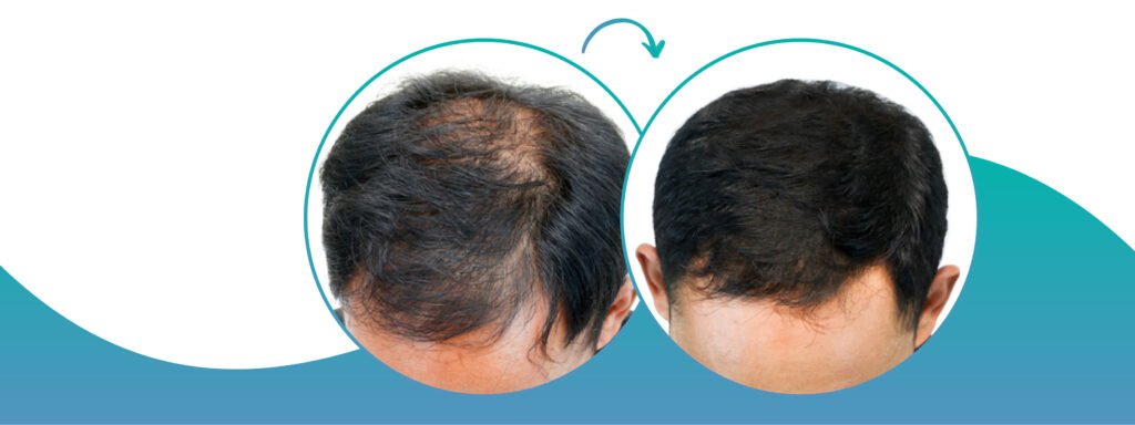 Busting myths about early intervention of GFC treatment for hair loss