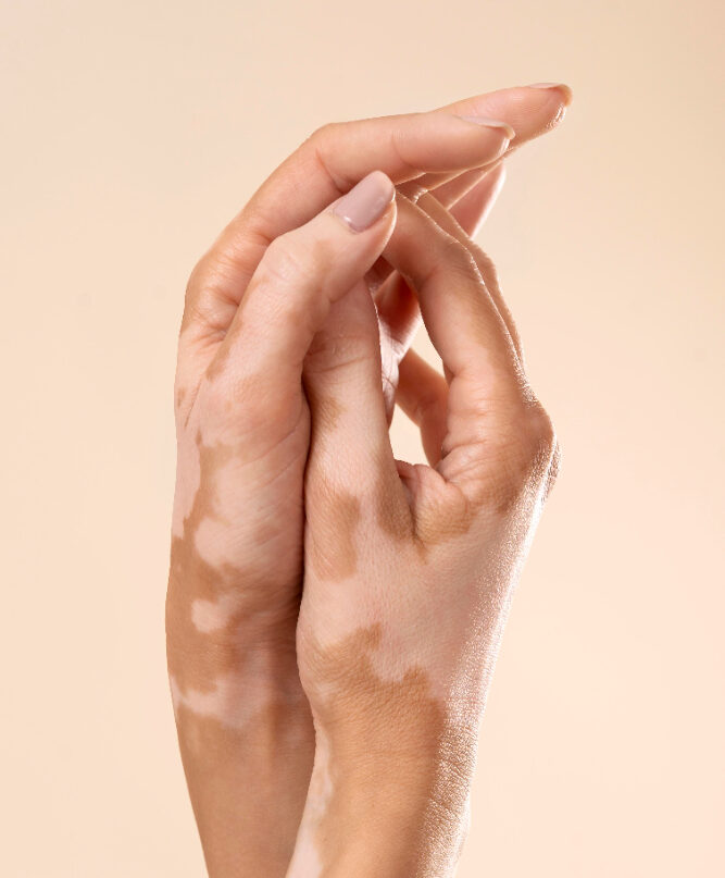 Comprehensive vitiligo treatment at Keha Skin Clinic – Hands showing white patches treated with advanced care.