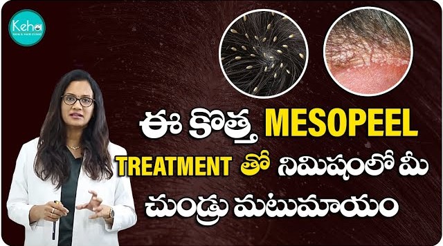 Best Dandruff Treatment