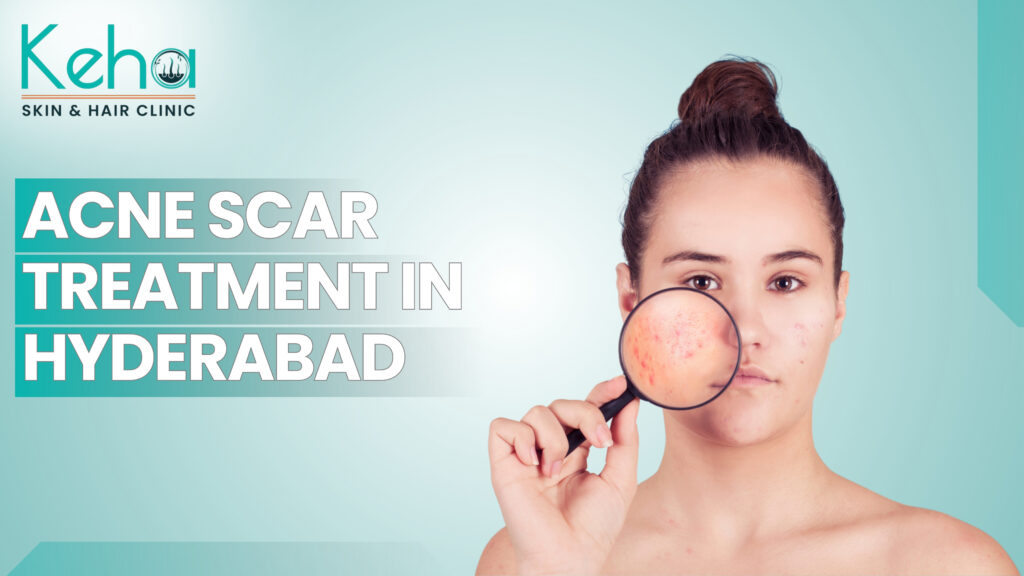 acne scar treatment in hyderabad