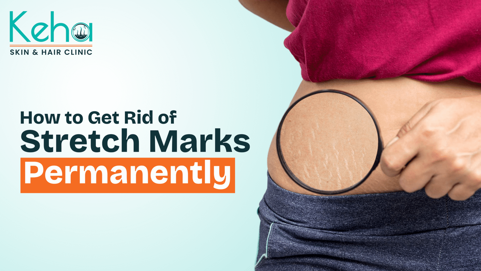 How to Get Rid of Stretch Marks Permanently – Keha Skin and Hair - Keha ...