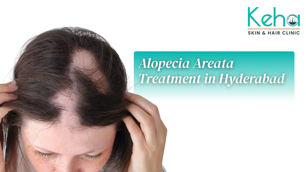 Alopecia Areata Treatment in Hyderabad at Keha Skin & Hair Clinic 1 Alopecia Areata treatment