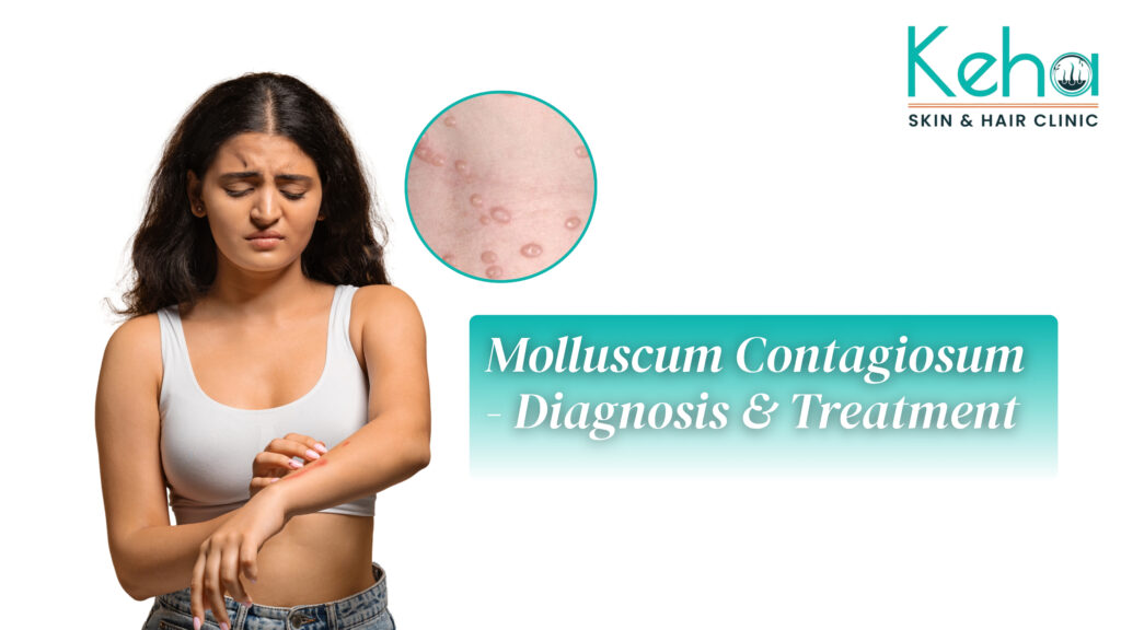 Molluscum Contagiosum - Diagnosis, Symptoms and Treatment 2 Molluscum Contagiosum