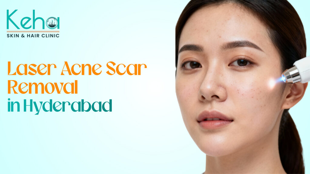 Laser Acne Scar Removal in Hyderabad: Safe & Effective Solutions at Keha Clinic 2 Laser acne scar removal in hyderabad